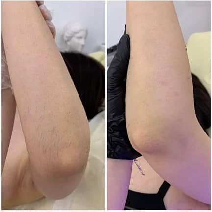 Лазерная эпиляция, салон MUZA, м. Парк Культуры, м. Кропоткинская