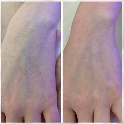 Лазерная эпиляция, салон MUZA, м. Парк Культуры, м. Кропоткинская